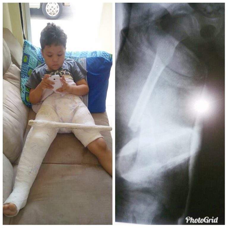 Solidariedade: o pequeno Miguel Vitor precisa da sua ajuda