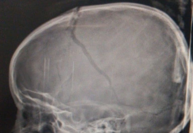 MENINA QUE CAIU DE TOBOÁGUA EM CATALÃO ESTÁ EM COMA INDUZIDO NO HUGOL, EM GOIÂNIA