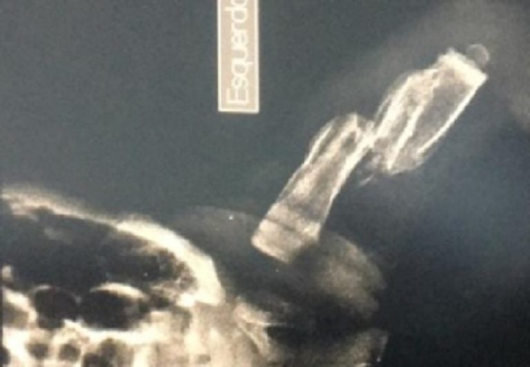 BEBÊ ESPANCADA EM TRINDADE FOI VÍTIMA DE AGRESSÕES CONTÍNUAS, APONTA LAUDO