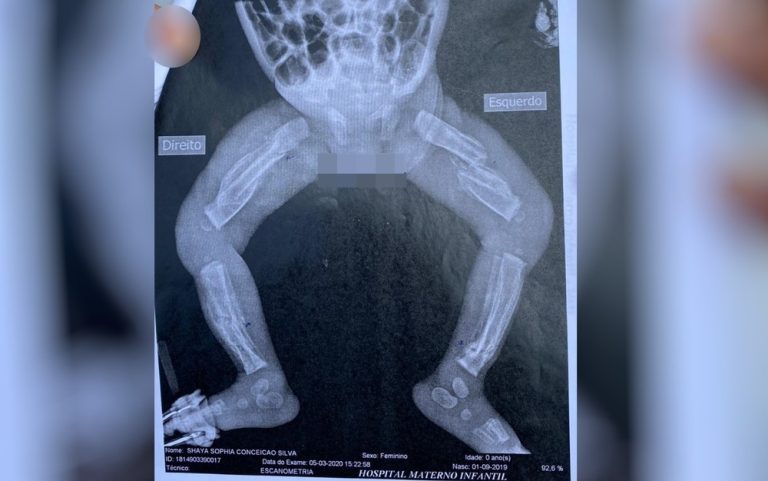 TRINDADE-GO: BEBÊ FOI ESPANCADA E DEU ENTRADA COM 12 FRATURAS E COM EDEMA CEREBRAL NO HMI, EM GOIÂNIA; PAIS SÃO OS PRINCIPAIS SUSPEITOS DAS AGRESSÕES