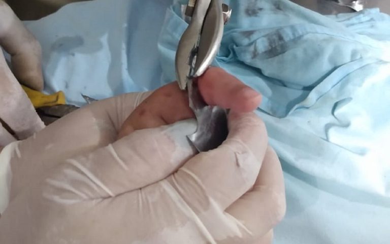 EM IPAMERI, CRIANÇA PRENDE DEDO EM RALO DO BANHEIRO E PRECISOU SER LEVADA PARA HOSPITAL PARA RETIRADA