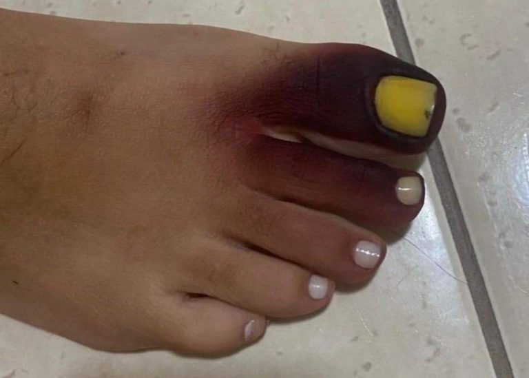 Mulher fica com pé roxo e unha amarela ao calçar tênis com piolho-de-cobra