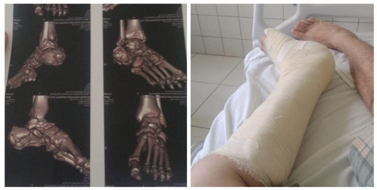 Homem que teve casa toda furtada precisa de 16 mil para cirurgia após acidente e pede ajuda, em Catalão