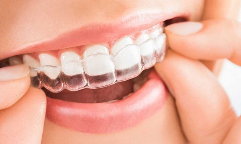 DICA PARA SUA SAÚDE BUCAL: Dr. Alexandre Goes, da Oral Unic Catalão, fala sobre os ‘Alinhadores Invisíveis’, a novidade na odontologia