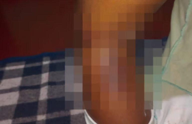 MÃE QUEIMA FILHA COM COLHER APÓS AGREDI-LA POR “COMER DEMAIS”, EM GOIÁS