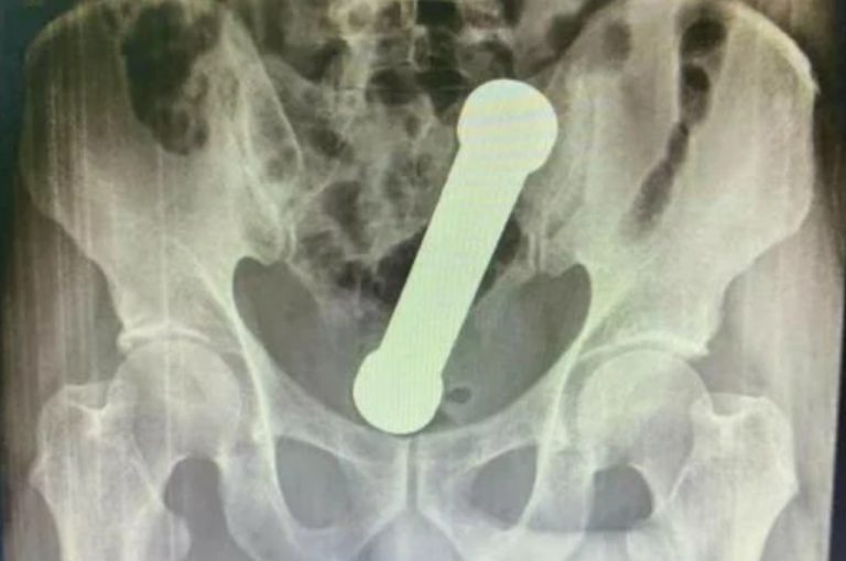 MÉDICOS ENCONTRAM PESO DE ACADEMIA DE 2 QUILOS DENTRO DE PACIENTE EM MANAUS