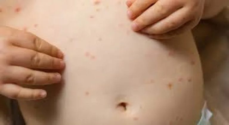 EXAMES DESCARTA INFECÇÃO POR SARAMPO NOS DOIS CASOS SUSPEITOS EM GOIÁS