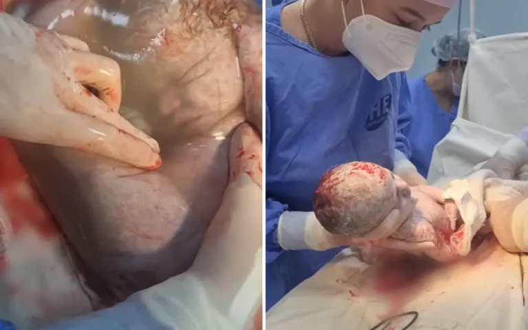 VÍDEO: EM PARTO RARO, BEBÊ NASCE EMPELICADO EM IPORÁ, NO INTERIOR DE GOIÁS