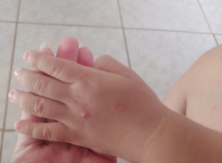 GOIÁS REGISTRA MAIS DE 600 CASOS SUSPEITOS DE SÍNDROME DE MÃO PÉ E BOCA: EM OUVIDOR, SÃO 13 CASOS