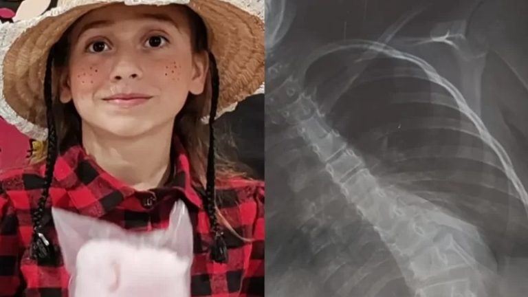 BADIINHO SOLIDÁRIO: CONTRIBUA PARA A COMPRA DE COLETE ESPECIAL PARA A GAROTA MELISA, DE APENAS 10 ANOS DE IDADE