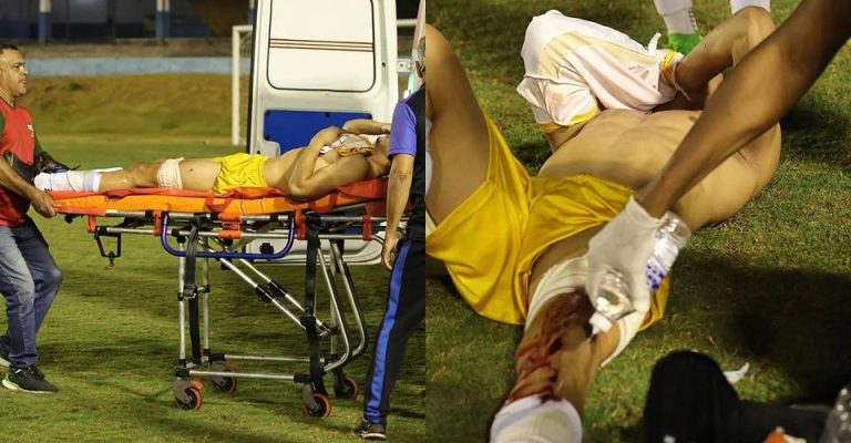 Goleiro do Grêmio Anápolis foi ferido por disparo de bala de borracha feito por policial; PM afirma que corregedoria apura o caso