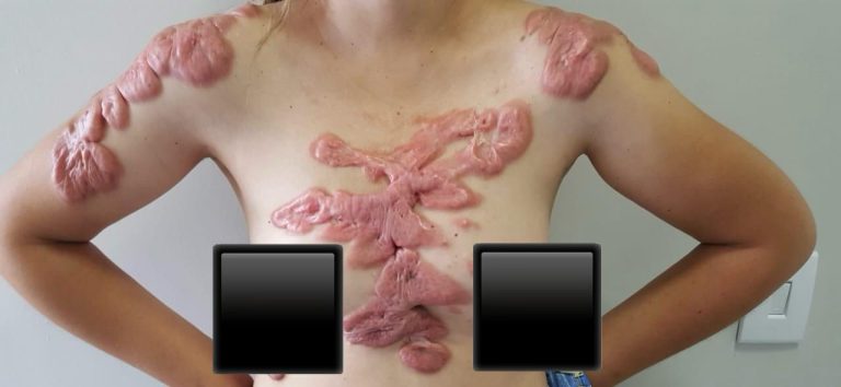 Moradora de Catalão enfrenta queloides graves e pede ajuda para seguir tratamento em São Paulo