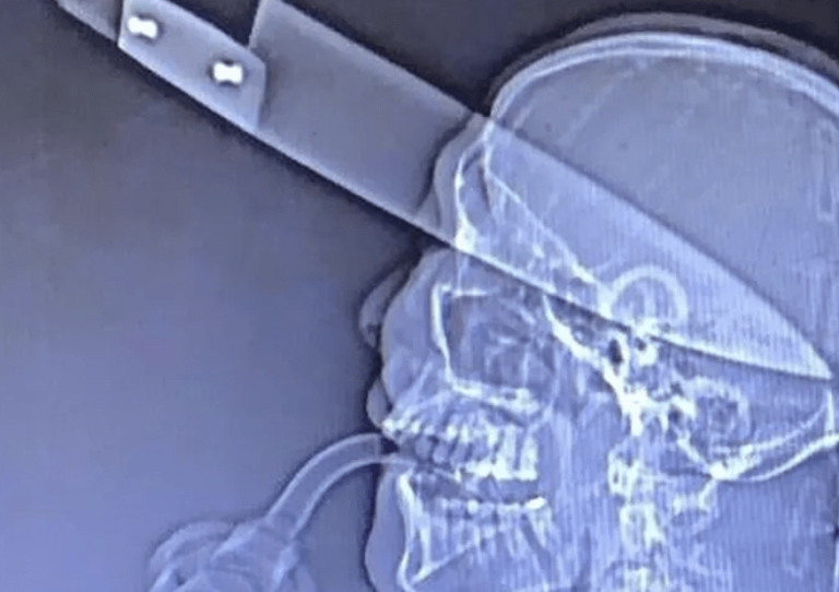 Homem ataca irmã e deixa faca cravada no olho em Campo Alegre de Goiás